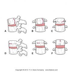 Six degrees of motion – from text
A. Flexion – Extension
B. Side bending (lateral flexion)
C. Rotation (ant. of vertebral body)
F. Compression – Distraction
D/E. Lateral shear
