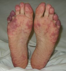 Prophylaxis: DVT / PE (Pulmonary Embolism)

ADRs:  BLEEDING
GI problems
Purple Toe Syndrome

NEED: Vitamin K supplements