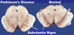 Degeneration in the substantia nigra