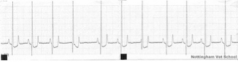 Which one of the following choices is the most likely finding consistent with myocardial hypoxia in the ECG below? 

A - Increased T amplitude
B - Alternating bradycardia and tachycardia
C - Variable complex intervals
D - ST segment depression
E - N