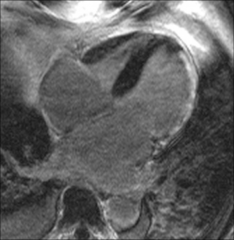 Acute M.R. due to 
papillary muscle dysfunction