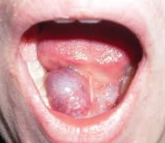 the obstruction of a salivary gland duct in the floor of the mouth