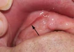 may be caused by ill fitting dentures