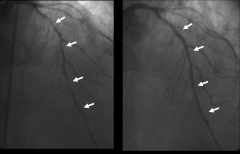 Diffuse LAD Disease
Before and After Four Drug-eluting Stents