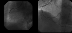 Myocardial Infarction: Right Coronary Artery
Left: STEMI
Right: NSTEMI