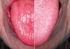 Has the symptom of a dry mouth (xerostomia)