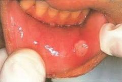 Round yellowish white lesions that affect 20% of the population