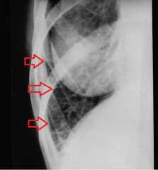 
What finding does this chest x-ray show?