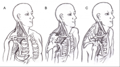 This image shows what SE of thoracic outlet syndrome?