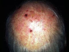 These skin lesions have been present for the past year. What is the most likely diagnosis?