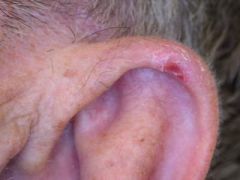 This patient complains of a painful 'spot' on his ear:

Which one of the following statements regarding this condition is correct?