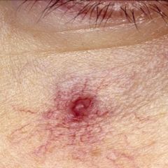 Please look at this skin lesion below a patient's sye:

Which one of the following medications is most associated with the development of these lesions?