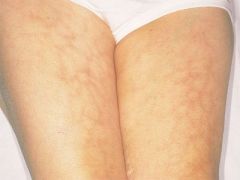 A 41-year-old woman shows you a rash on her legs:

What is the most likely cause of such a rash?