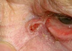 Please look at the skin lesion shown below:

What is the most likely diagnosis?