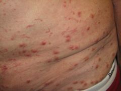 A 41-year-old man presents with an itchy rash over his arms and abdomen. It has got gradually worse over the past three days.

DX