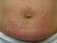 A woman who is 30 weeks pregnant asks you about an itchy rash on her abdomen:

What is the most likely diagnosis?