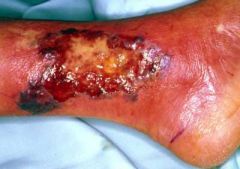 The lesion below started as a small red papule which grew in size before starting to ulcerate:

Which one of the following conditions is most associated with this skin condition?