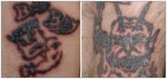 This patient is getting a PPD test... but you notice something funny... His 30 year old tattoos have flared up recently. What condition might this patient have that might make a PPD test not work?