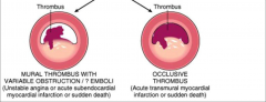 If penetration of blood into lipid core thrombosis results with partial or total occlusion.