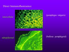 pemphigus vulgaris= desmoglien 3
"net like"

bullous pemphigoid=hemidesmosomes