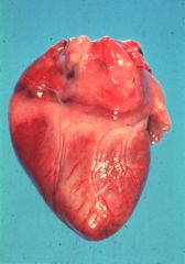 Myocarditis - typically leading to sudden death due to heart failure or at least permanent scarring. (Notice the necrotic, white areas in the myocardium)