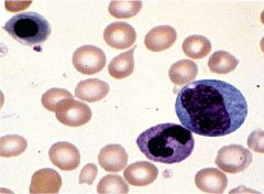 13-1: Leukoerythroblastic reaction. The solid arrow


shows a teardrop RBC. Immature myeloid cells are also


present in a nucleated RBC (interrupted arrow).