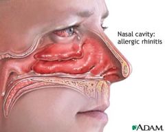 the infection has caused inflammation of the nasolacrimal ducts