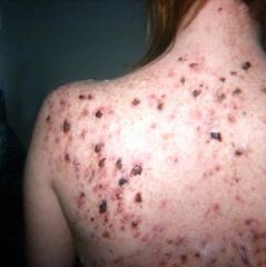 Severe acne with burrowing & interconnecting abscesses and irregular scars