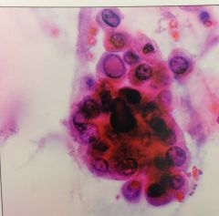 pic of psammoma bodies in resp specimen. assoc with?