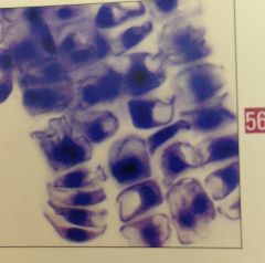 picture of square cells with no chromatin pattern and refractile walls in sputum. most likely dx?