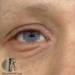  Double fold of skin over lower eyelid from rubbing


-Atopic eczema