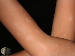 White slightly scaly areas on arms and face of children with atopic eczema 
