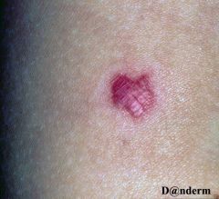 Reddish brown nodule in child or young adult on upper arms and face. Benign