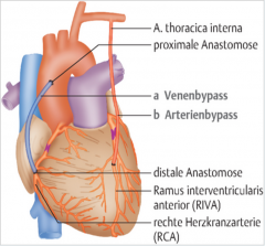 - bevorzugt arterielle (längerer Lebensdauer nach 10J 90% offen)


- Am häufigsten: linke A. thoracica (mammaria) interna (LIMA: left internal mammary artery) (bleibt verbunden mit A. subclavia)


- venöser Gaft: V. saphena magna (10J 50% o...
