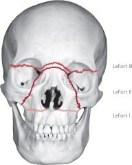 I: upper jaw mobile
II: upper jaw and nose mobile, CSF rhinorrhea
III: upper jaw, nose, maxilla, zygoma mobile. CSF rhinorrea

At require Abx and surgery