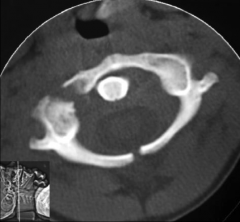 Which fracture is shown in this CT scan? 