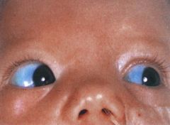 Glaucoma-first screen these kids with a full ophthalmologic evaluation (Buphthalmos is pictured above)

Other associations include
-Facial port wine stains in V1 distribution (more common if bilateral facial lesions)
-Neuro complications inclu...