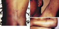 Several tan to light brown patches/macules over trunk are observed -what is your next step?