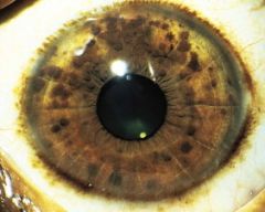 These are cafe au lait spots. IF you see a large (>3 cm) or multiple lesions (>6) then you may suspect Neurofibromatosis

Other characteristics include positive family hx, possible eye complications including optic glioma (and Lisch nodules show...