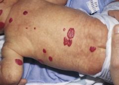 What locations of infantile hemangiomas warrant referral or further investigation?
