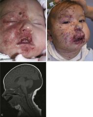 Large segmental facial hemangioma puts child at risk for this syndrome. 
Posterior fossa abnormalities (dandy walker syndrome)
Hemangioma
Arterial anomalies (usually intracerebral)
Cardiac defects, esp coarctation
Eye abnormalities