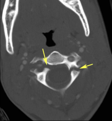 In this CT scan, which fracture is shown? 