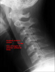 Which type of flexion compression fracture? 