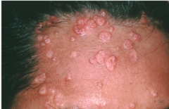 Rash on forehead which has not gone away for months. What is probably in the past medical history?
A. Psoriasis
B. Eczema
C. HIV
D. Acne
E. Rosacea