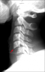 What causes complete anterior dislocation of the vertebral body causing cord damage? 