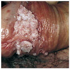 What type of warts? Most common what? Range of appearance? Locations (3)? 
What virus(es) cause 90%? Other 10%?
