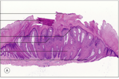 Label the wart histology:
 
Tissue fold, acanthosis, koilocytes, focal hemorrhage, rete ridge slopes inward, hyperkeratosis, hypergranulosis