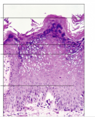 Label the wart histology:
 
Acanthosis, koilocytes, hypergranulosis, hyperkeratosis