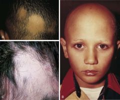 Alopecia and nail pits?