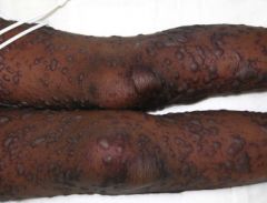SJS/erythema multiforme major: acutely ill, prodromal symptoms of fever and malaise. Mucuous membrane invovlement occurs first followed by skin involvement. Must have 2 mucous membranes involved. if >10% of skin denuded then diagnosis is TEN.

C...